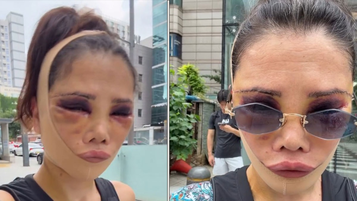 Didem Ceran yeniden bıçak altına yattı: Son halini paylaşıp eleştirmenlere sert çıktı